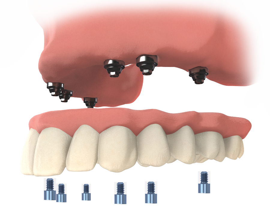 Full Arch Implant Icon